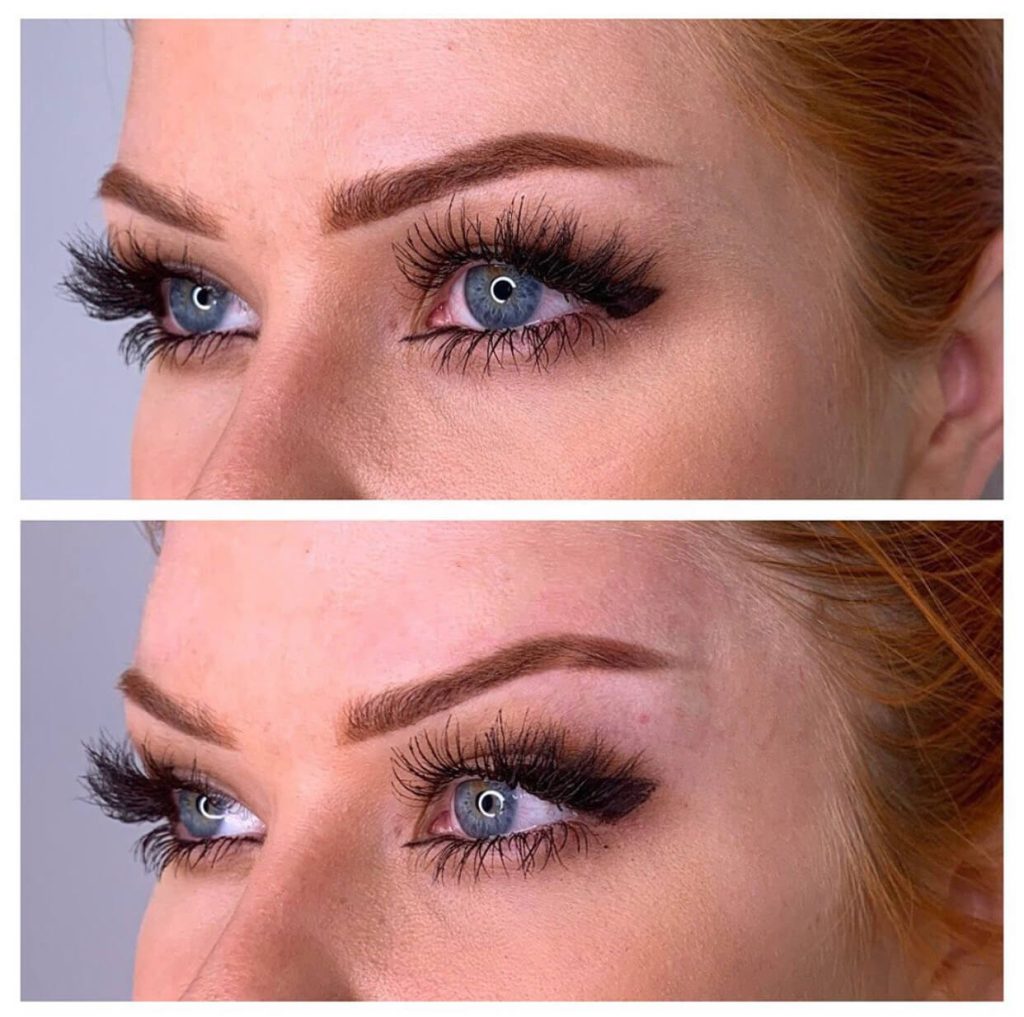 لیفت ابرو با نخ کلینک زیبایی موتاکس