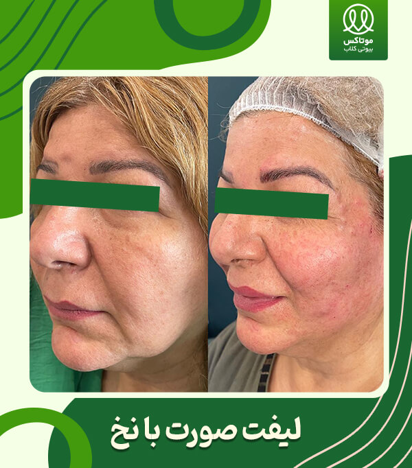 لیفت صورت با نخ