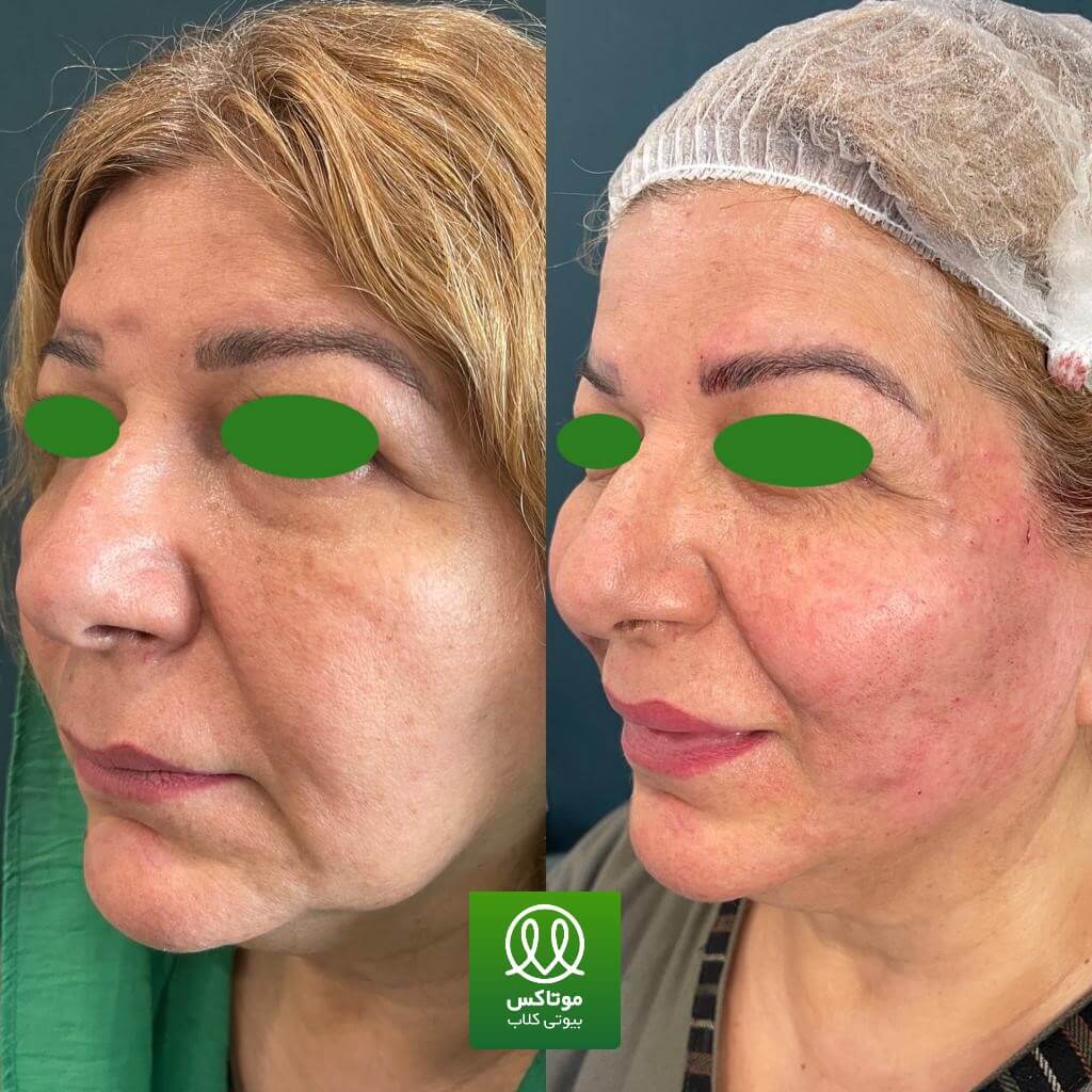 لیفت صورت با نخ