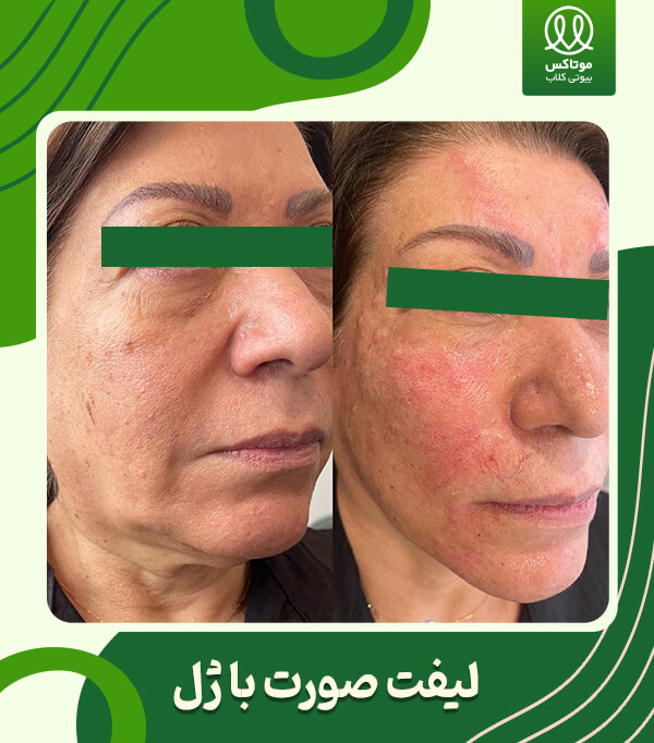 لیفت صورت با ژل و فیلر زیر چشم