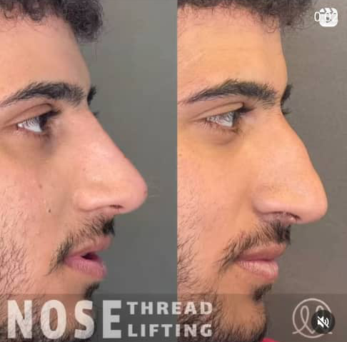 لیفت بینی با نخ