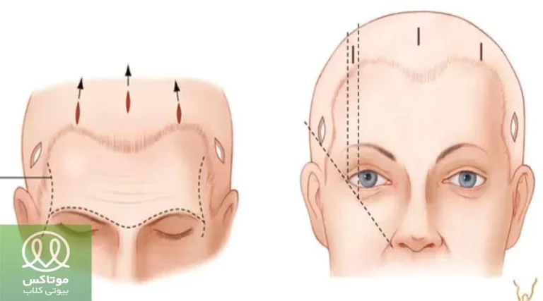 لیفت آندوسکوپیک چیست