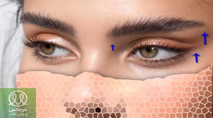 لیفت آندوسکوپیک ابرو