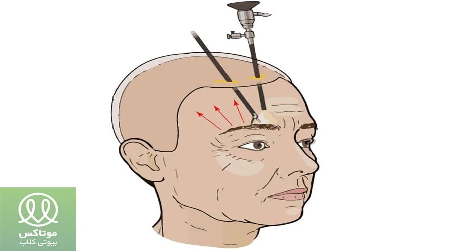 روش انجام لیفت آندوسکوپیک ابرو