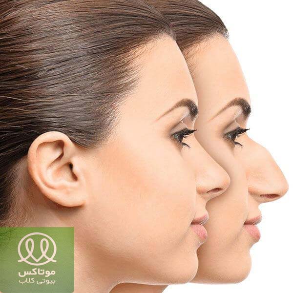 اصلاح قوزبینی با لیفت