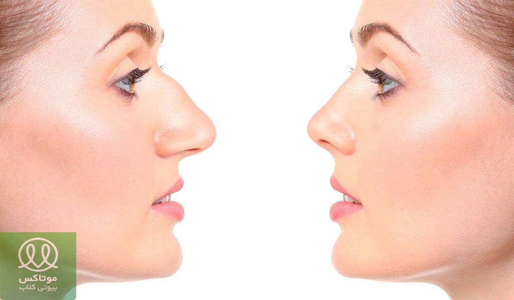 اصلاح فرم بینی با لیفت