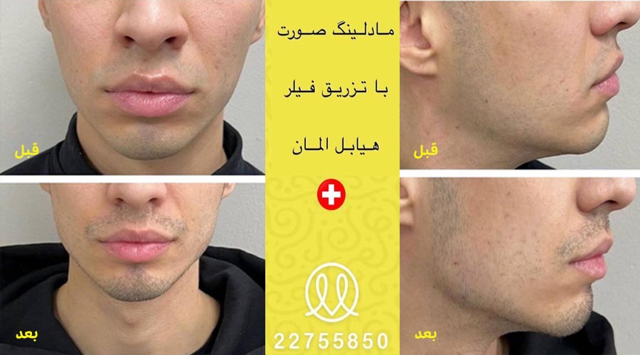 نمونه کار مادلینگ صورت در کلینیک موتاکس