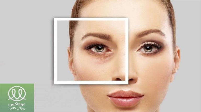 درمان خانگی افتادگی پلک