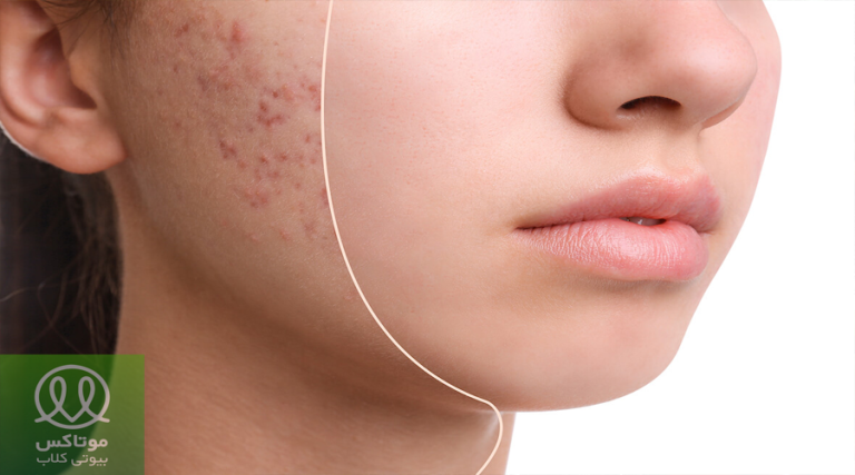 علت جوش صورت در خانم ها
