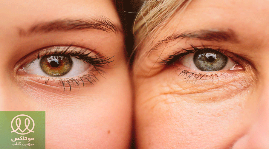 تزریق فیلر برای رفع چروک دور چشم