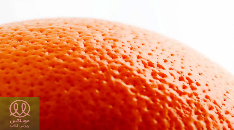 سلولیت پوست پرتغالی