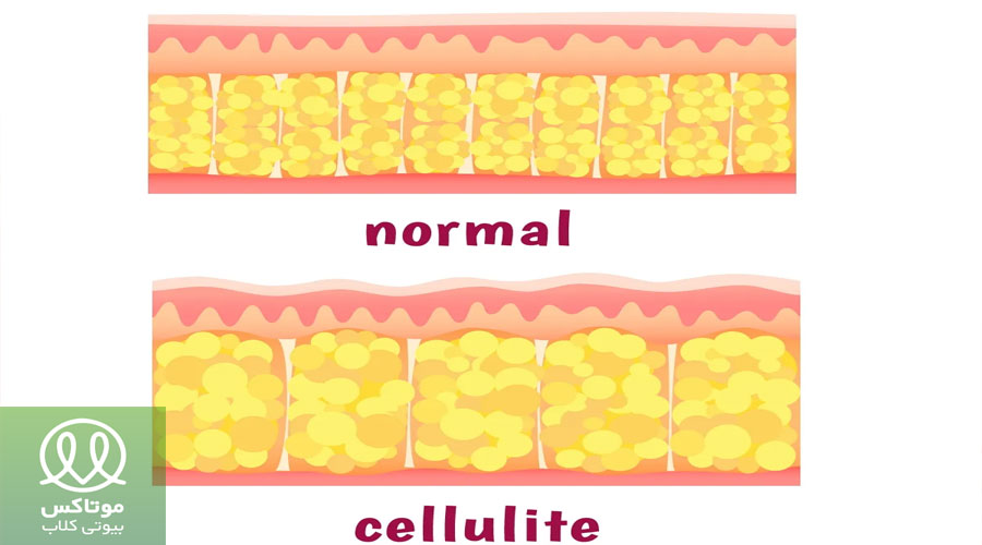 ظاهر پوست در سلولیت