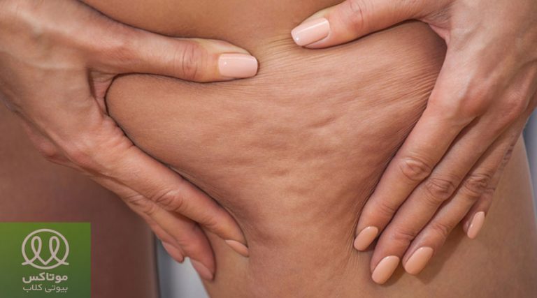 روش درمان سلولیت پا