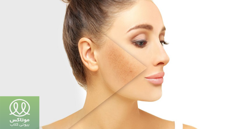 سریع ترین راه از بین بردن لک صورت
