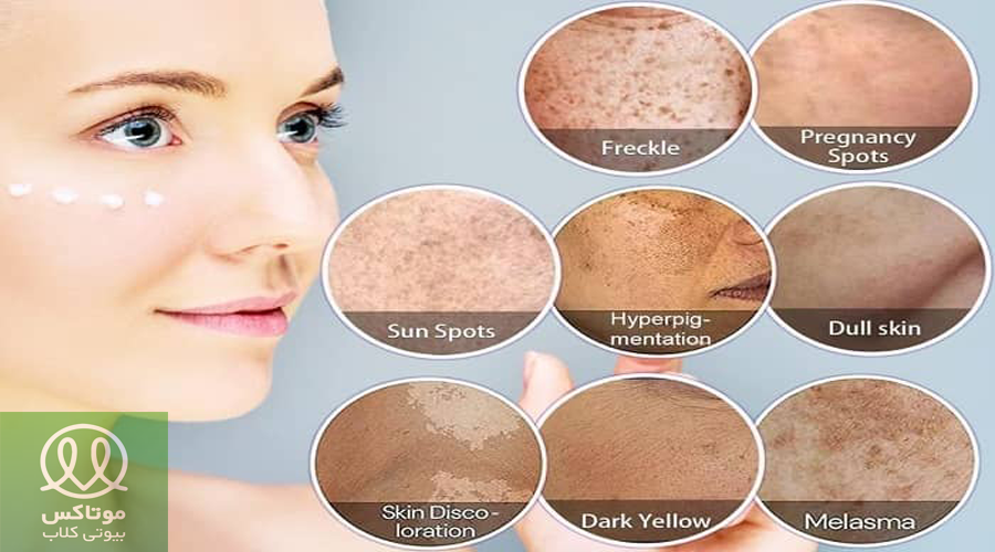 انواع لک پوستی