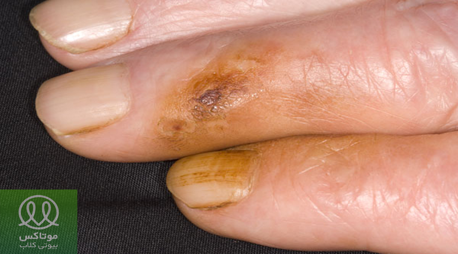 زرد شدن رنگ دست