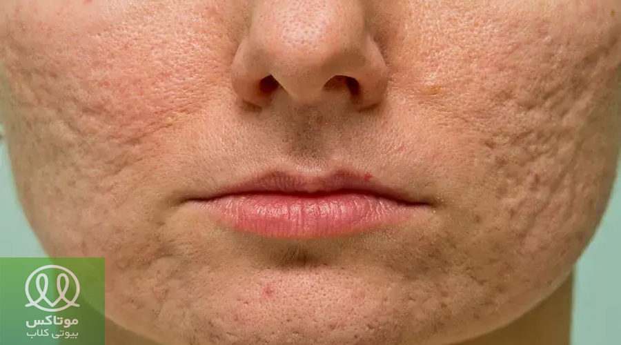 جوش و اسکار پوستی