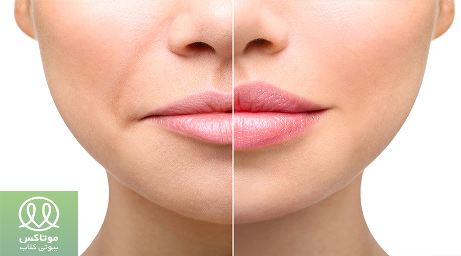 تزریق فیلر به لب