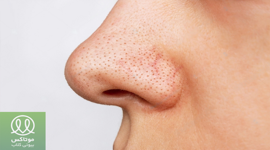 ظاهر جوش سر سیاه