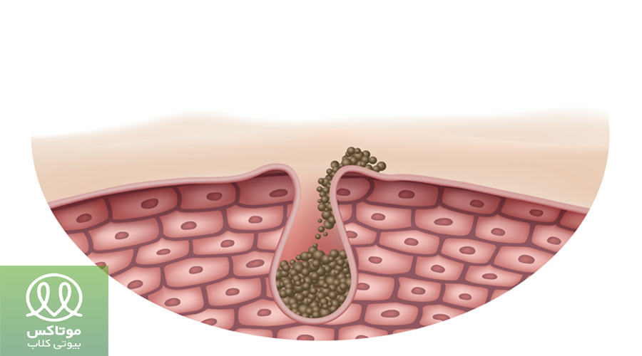 علت ایجاد جوش سر سیاه