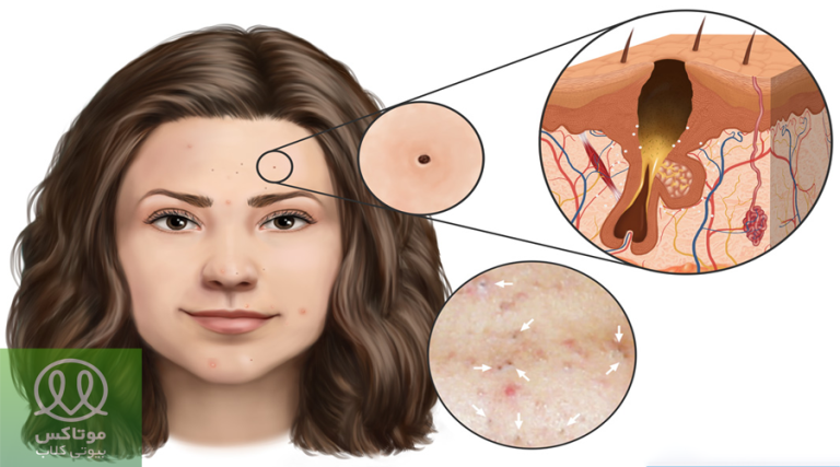 رفع جوش سر سیاه