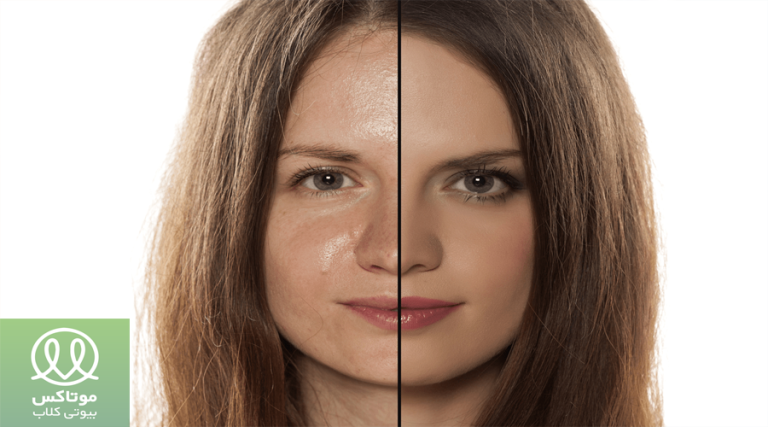 علت چرب شدن پوست صورت