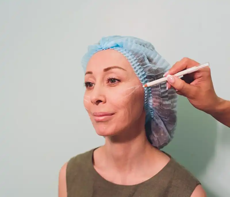 لیفت صورت با نخ چقدر ماندگاری دارد؟