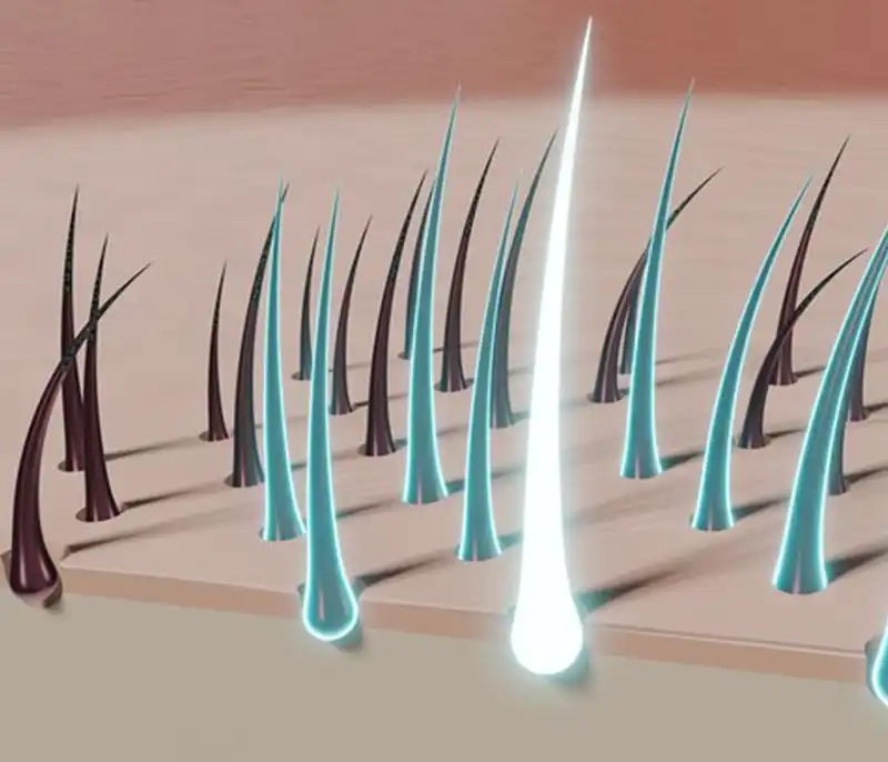 فاصله بین جلسات لیزر موهای زائد