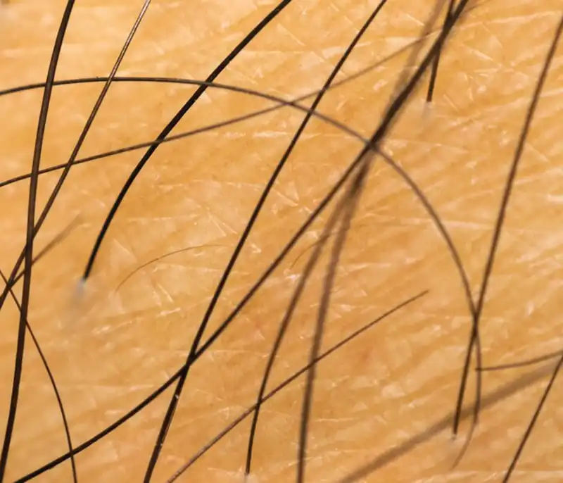 اگر فاصله بین جلسات لیزر افزایش یابد، چه اتفاقی میافتد؟