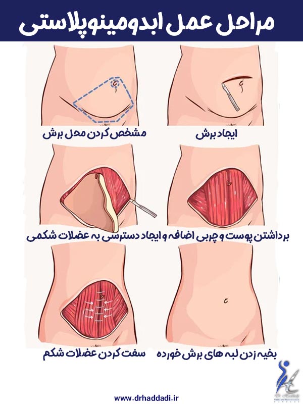 ابدومینوپلاستی