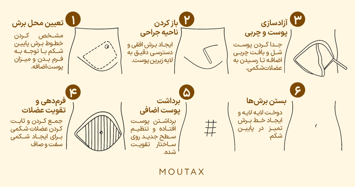 ابدومینوپلاستی شکم