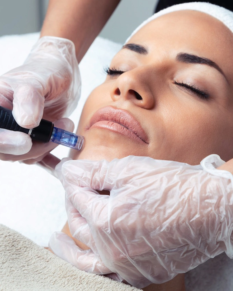 مزوتراپی صورت